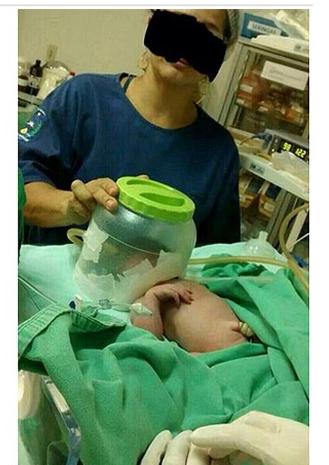 Médica Utiliza Pote de Plástico Como Capacete de Oxigênio para Salvar Bebê